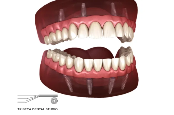 All-on-4 Dental Implants In NYC