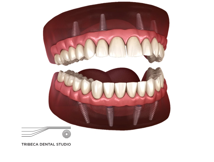 All-on-4 Dental Implants In NYC