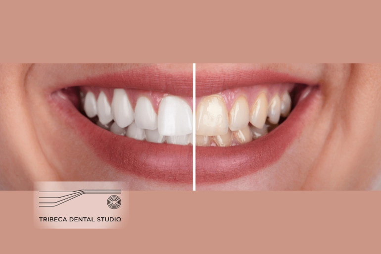 Teeth whitening At Tribeca Dental Studio