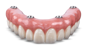 Final prosthesis after healing