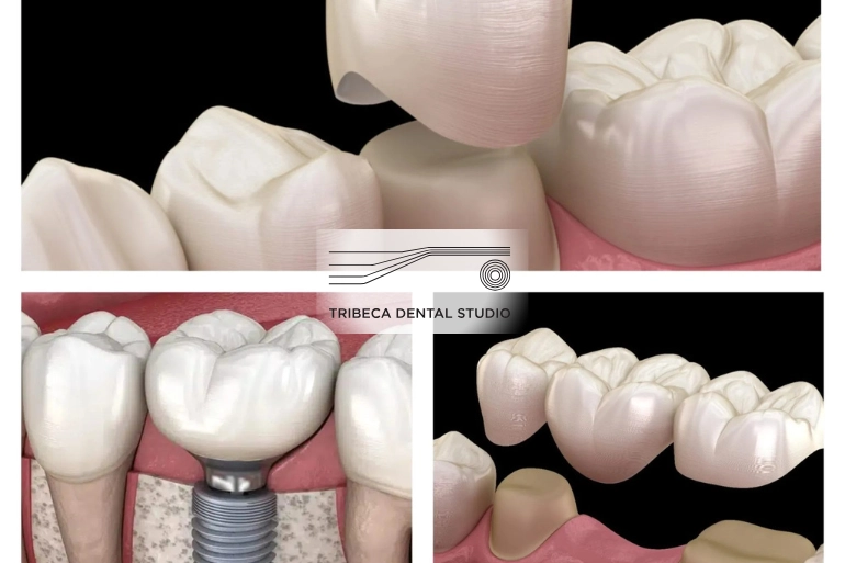 Crowns and Bridges | Tribeca Dental Studio