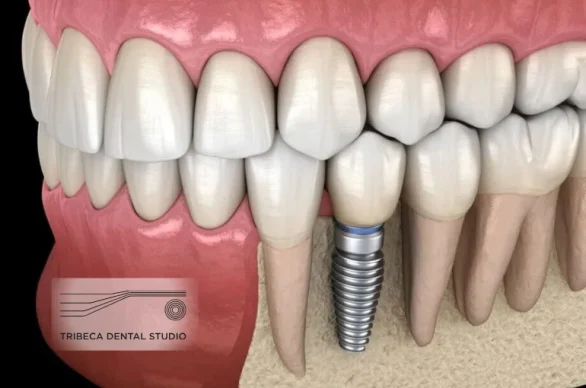 Dental Implants | Board-Certified Implant Specialist Dr. Sam