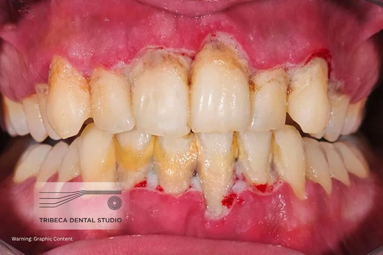 Early Signs of Gum Disease