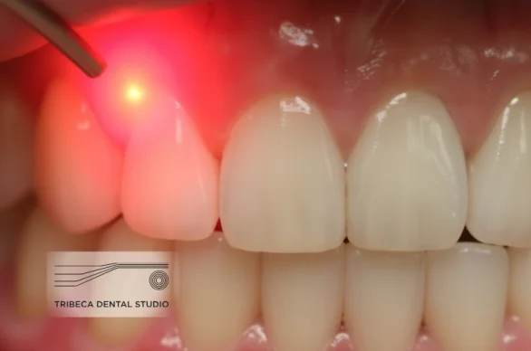 Laser gum therapy in NYC