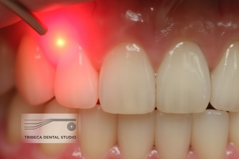 Laser gum therapy in NYC