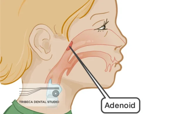 MARPE Palatal Expansion for Children