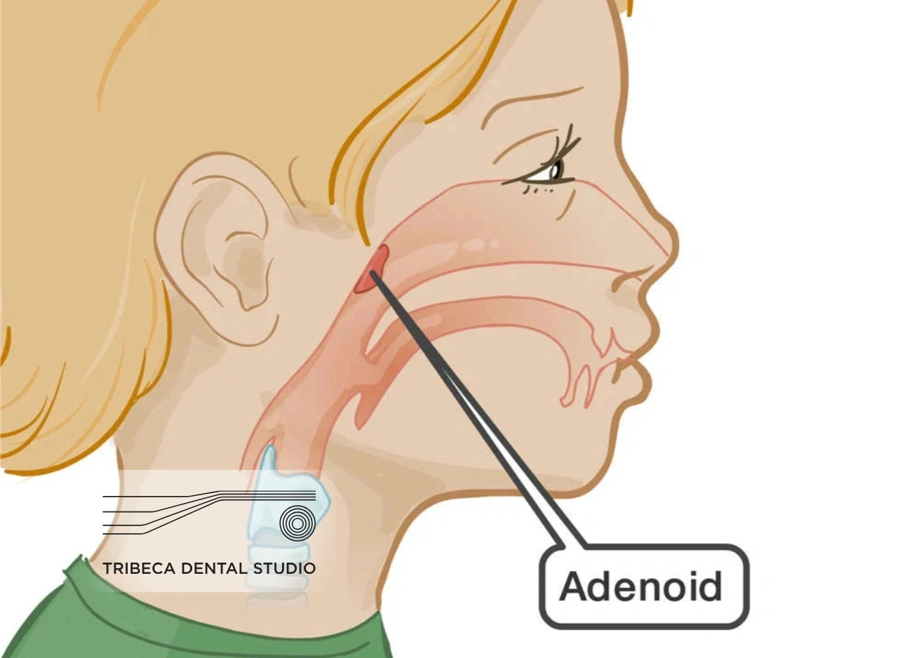 MARPE Palatal Expansion for Children
