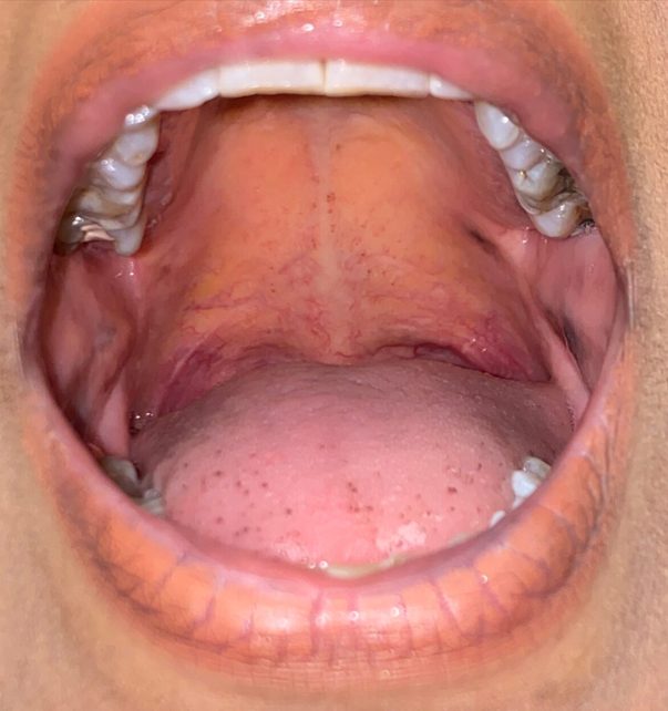 Before Treatment