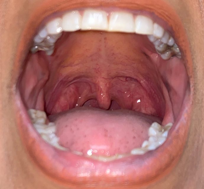 After Treatment