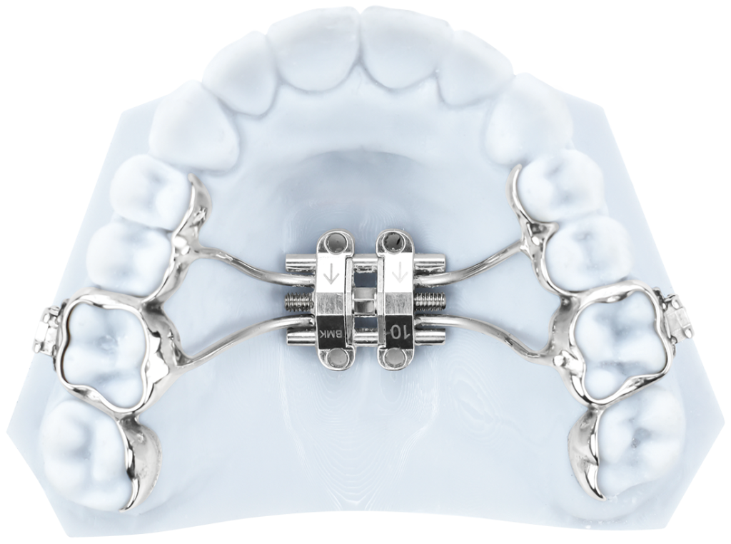 marpe-with-3d-metal-printed-bands