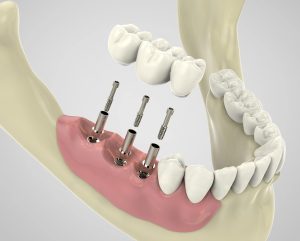 Expert surgical placement
