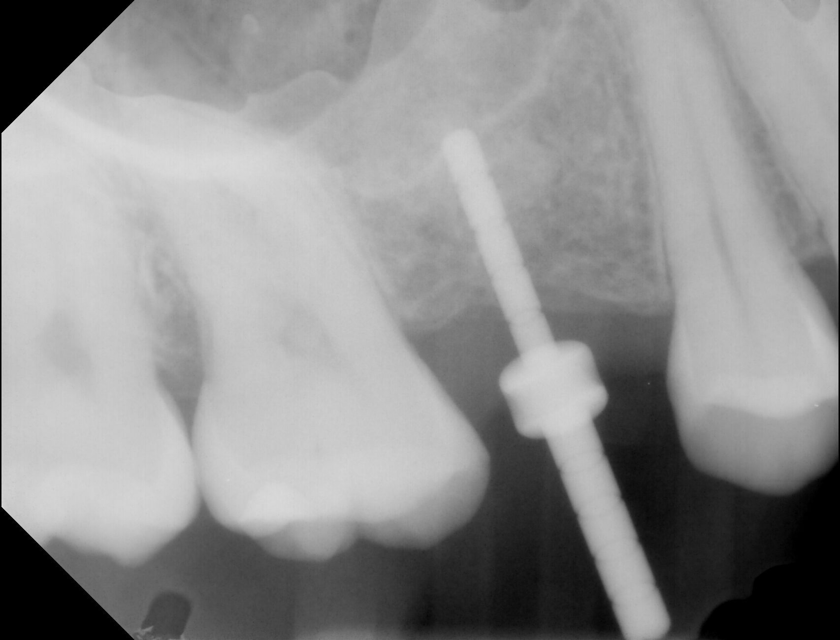 dental implant components