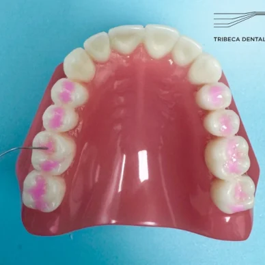 Dental Sealants in Lower Manhattan NYC
