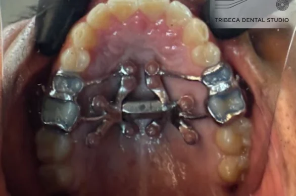 (MARPE) Palatal Expansion in NYC at Tribeca Dental Studio Airway Orthodontics
