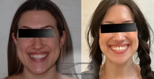 Maxillary Skeletal Expansion (MSE) In Tribeca, NYC