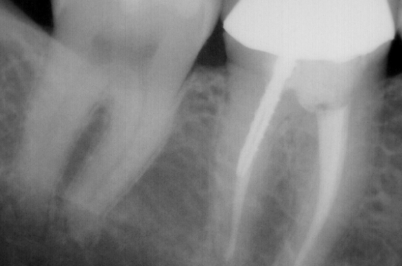 Root Canal Treatment At Tribeca Dental Studio