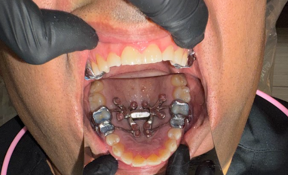 MARPE at Tribeca Dental Studio