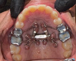 MARPE at Tribeca Dental Studio