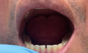 Dental Filling Before
