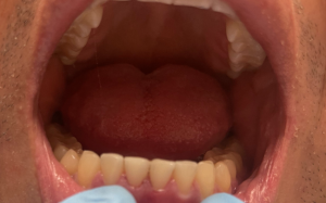 Dental Filling After