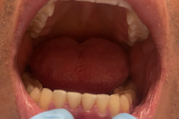 Dental Filling After at Tribeca Dental Studio