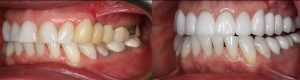 Before and After Veneers by Dr Igor Chikunov