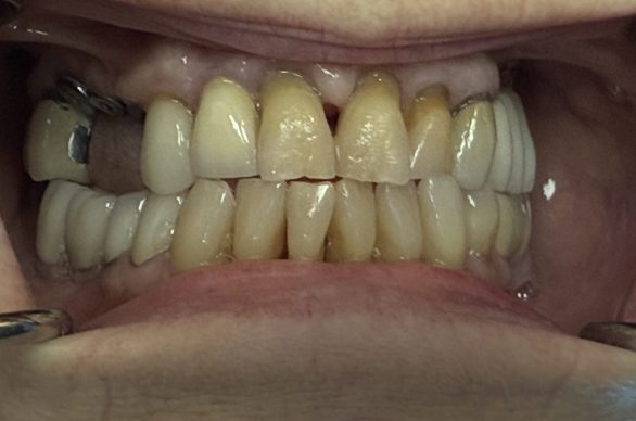 Real Implant Temporary Bridge Case. Before