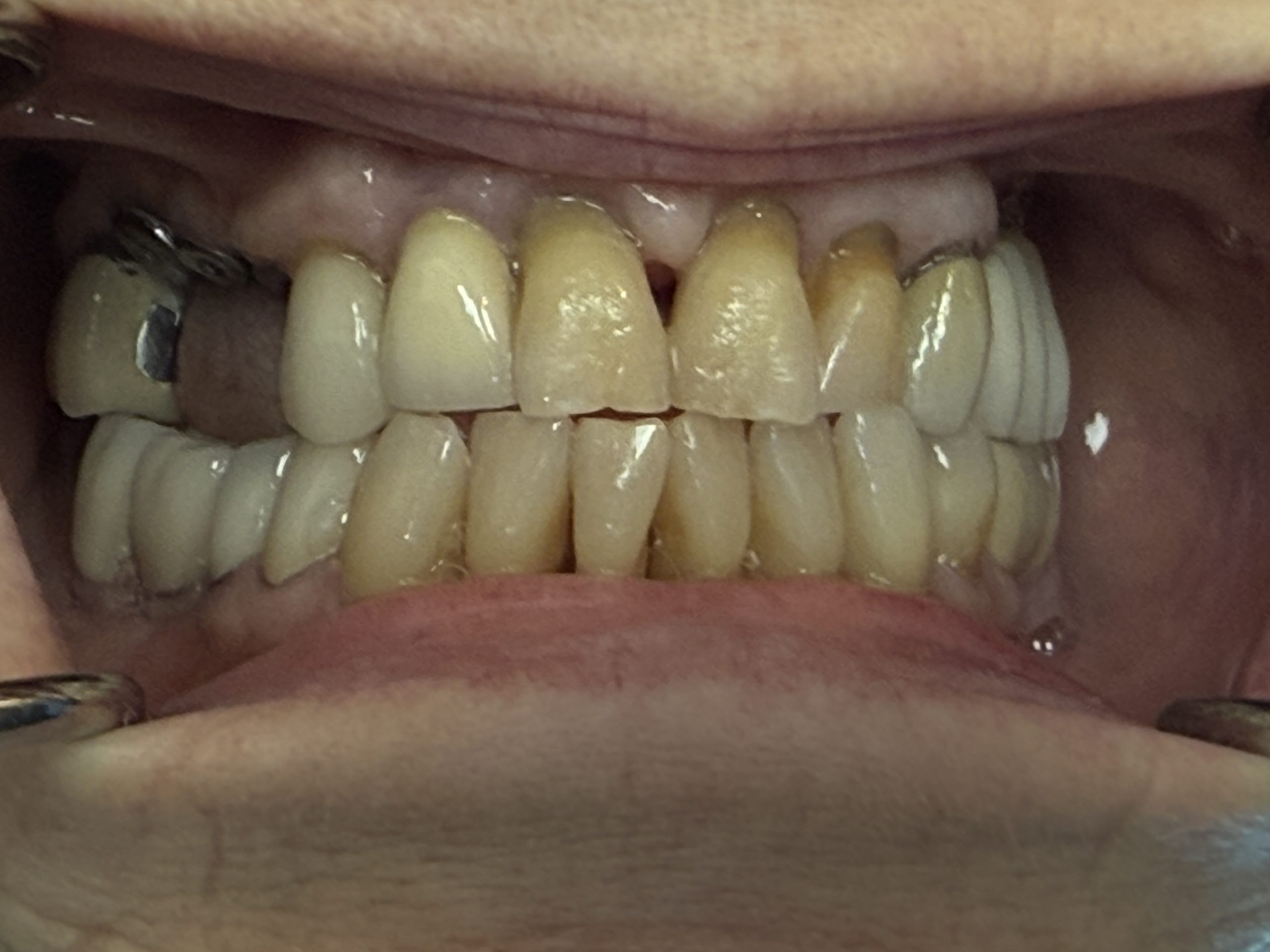 Real Implant Temporary Bridge Case. Before