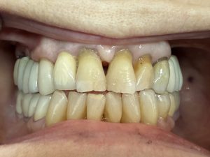 long-term tooth wear from untreated overbite long-term tooth wear from untreated overbite