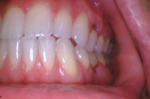 Gum Recession at Tribeca Dental Studio