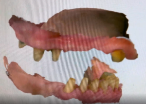 Severe upper jaw bone loss preventing traditional dental implants – before photo at Tribeca Dental Studio, NYC