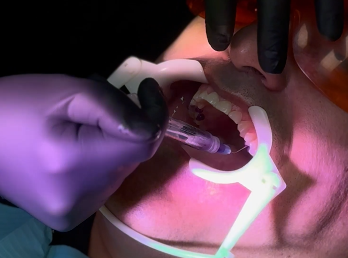 dry socket treatment NYC