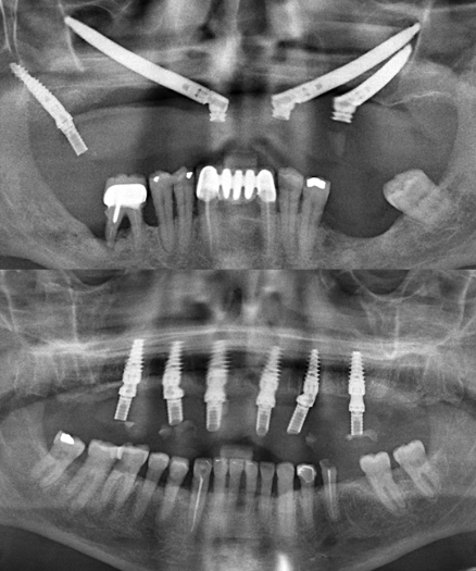 Best Dental Implants. Tribeca Dental Studio All on 6 vs Zygomatic implants