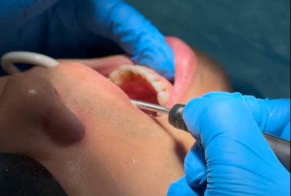 Dental Crown After Filling