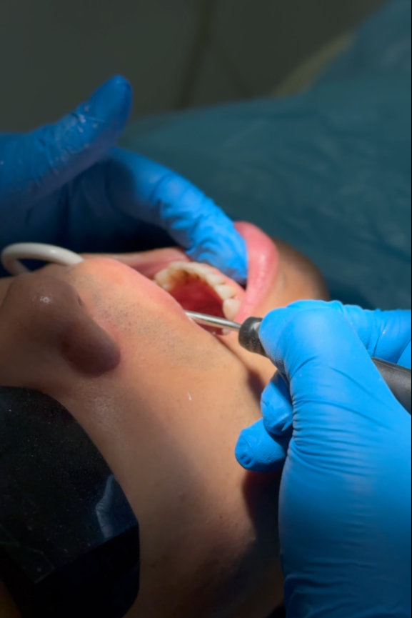 Dental Crown After Filling