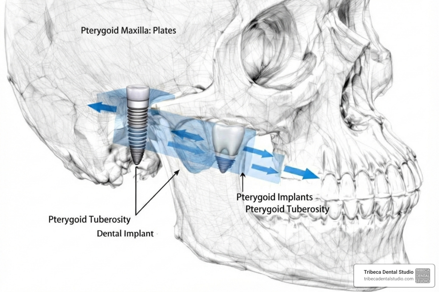 pterygoid implants anatomy