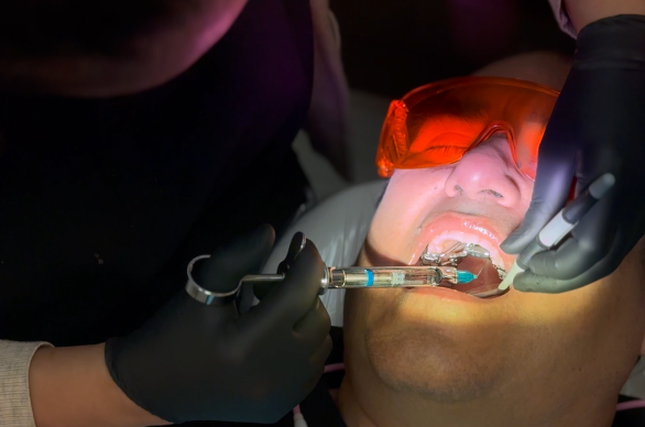 what to expect when getting a filling