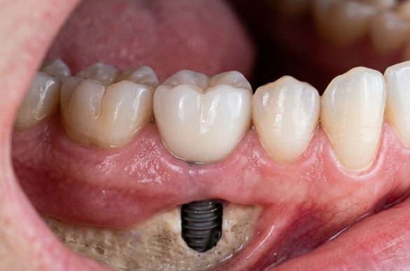 zirconia dental implants nyc