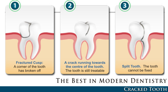 fixing a broken crown tooth