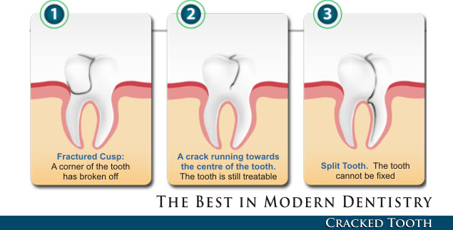fixing a broken crown tooth