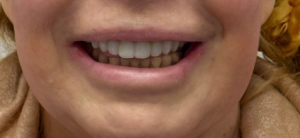 perfect white teeth