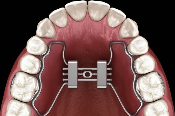 narrow palate treatment