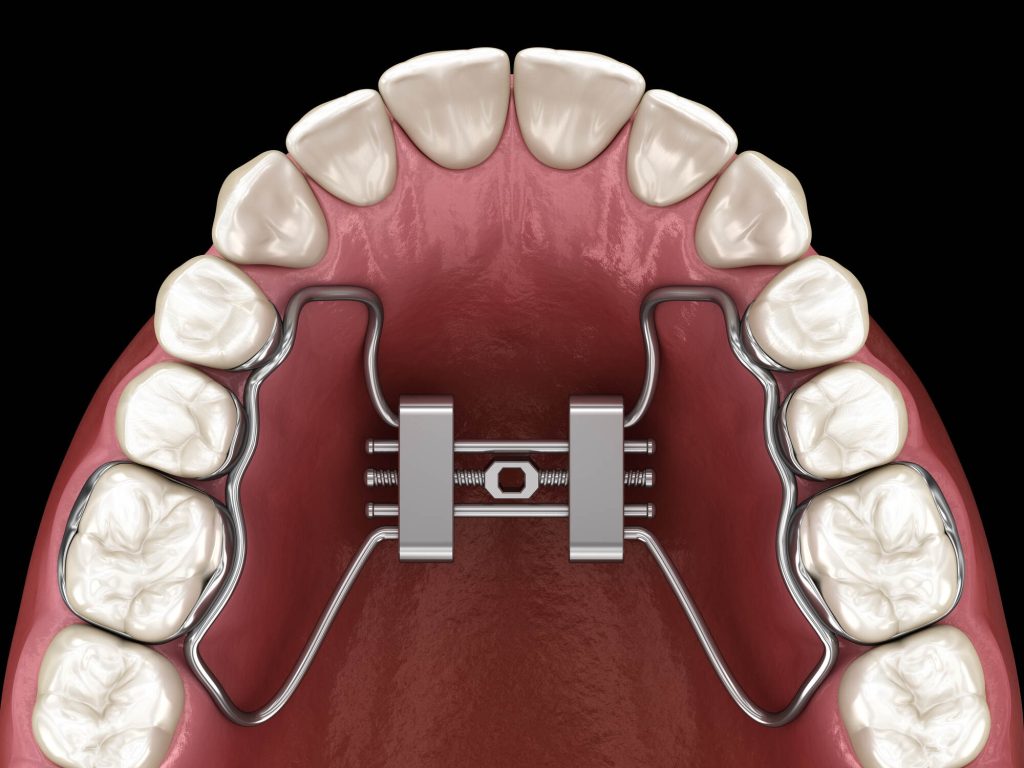 narrow palate treatment