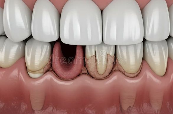 cavity filling vs crown dental restoration
