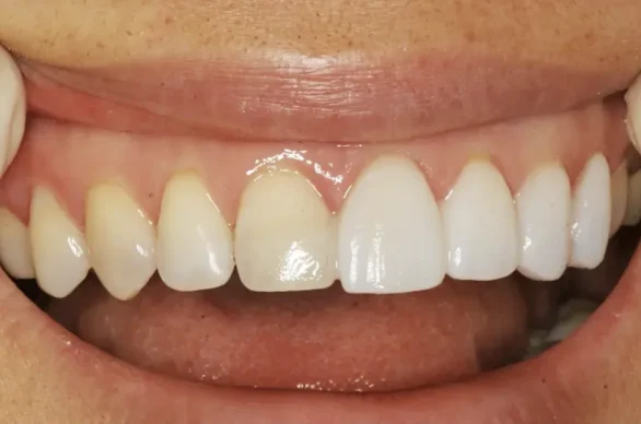Veneers vs crowns: thin laminate covers front of tooth, crown encases entire tooth.