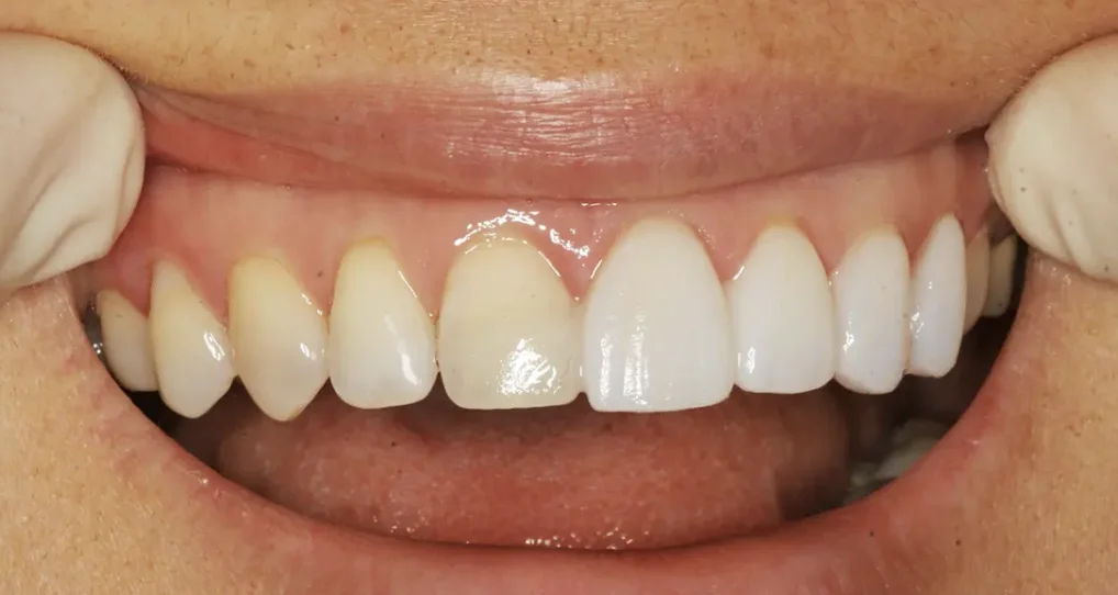Veneers vs crowns: thin laminate covers front of tooth, crown encases entire tooth.