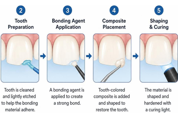 Step-by-step process of dental bonding for a chipped tooth
